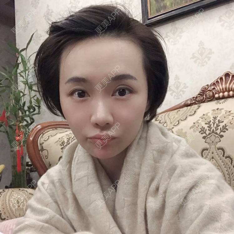 更美 - 勾勾手指剂的皮秒激光经验 | 皮秒激光 | 无锡