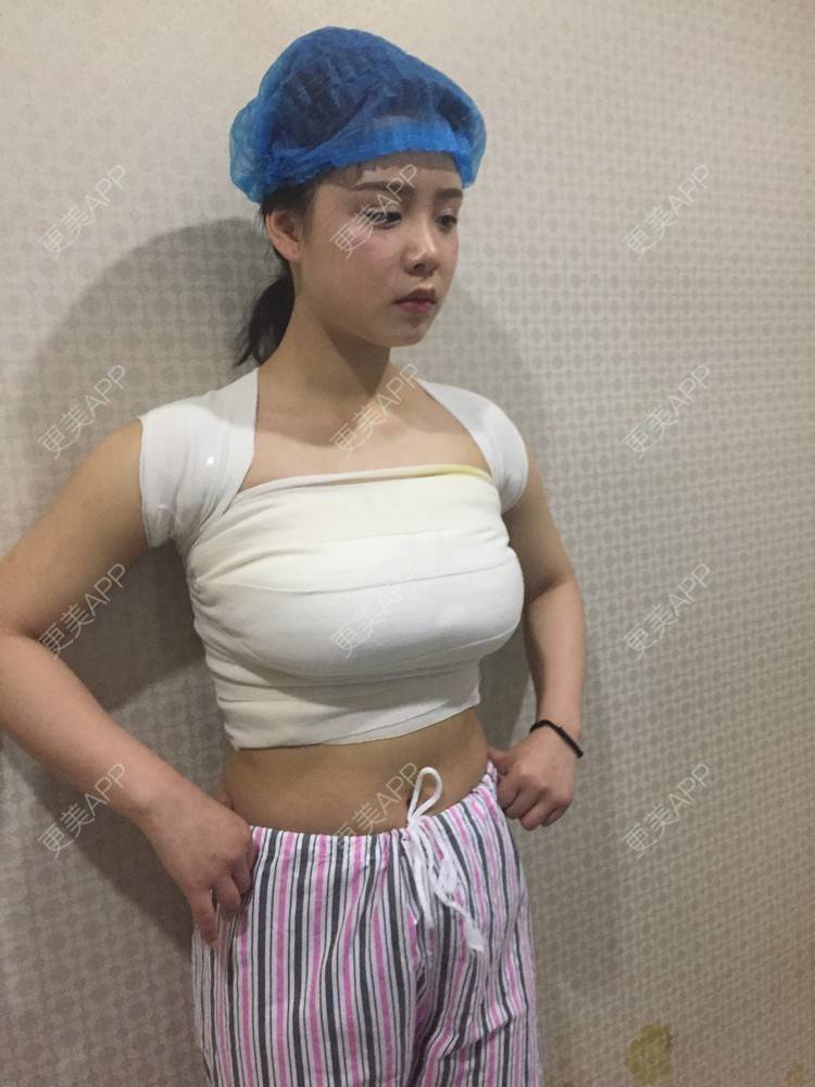 更美 - 更美用户cig0hiG4vJ的自体脂肪隆胸经验 | 自体脂肪隆胸 | 长沙