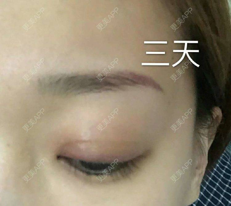 更美 - ゛只想与你走⌒悠的激光洗眉经验 | 激光洗眉 | 广州