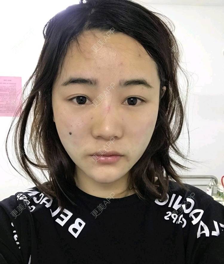 更美 - 刘茜 医生的埋线提升经验 | 埋线提升 | 无锡