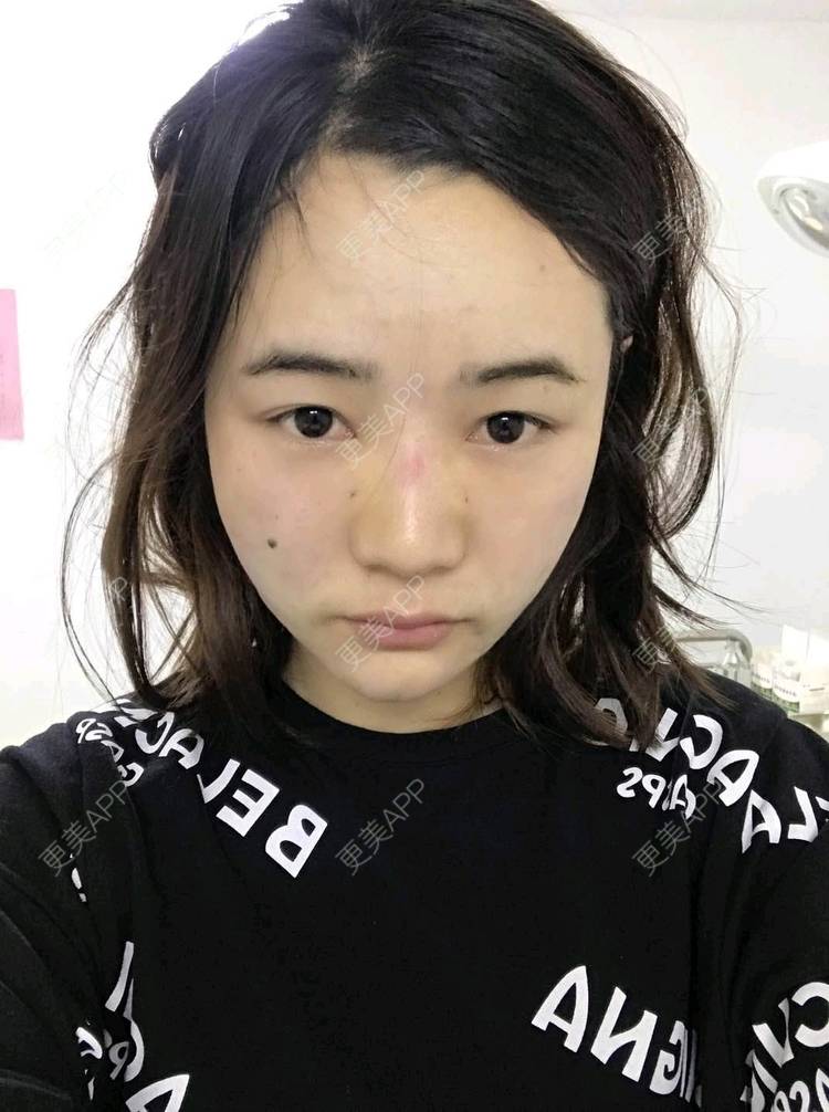 更美 - 刘茜 医生的埋线提升经验 | 埋线提升 | 无锡