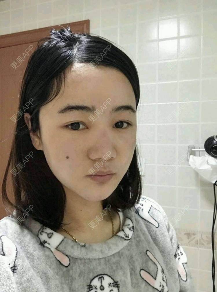更美 - 刘茜 医生的埋线提升经验 | 埋线提升 | 无锡