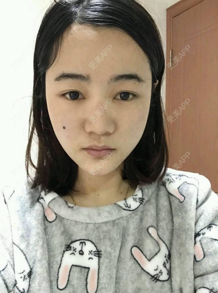 更美 - 刘茜 医生的埋线提升经验 | 埋线提升 | 无锡