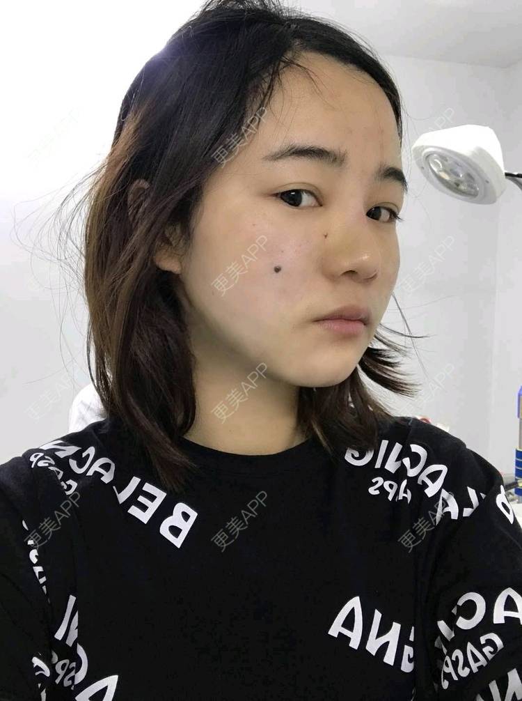 更美 - 刘茜 医生的埋线提升经验 | 埋线提升 | 无锡