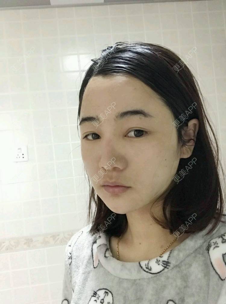 更美 - 刘茜 医生的埋线提升经验 | 埋线提升 | 无锡