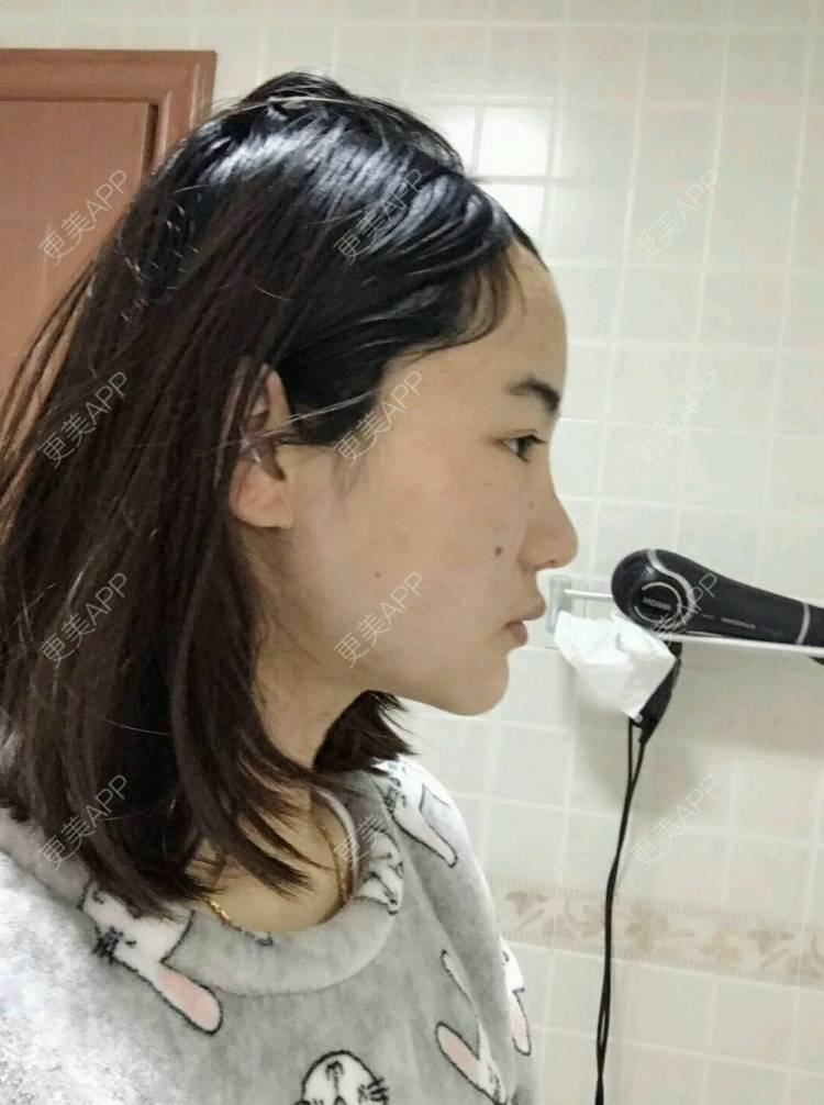 更美 - 刘茜 医生的埋线提升经验 | 埋线提升 | 无锡