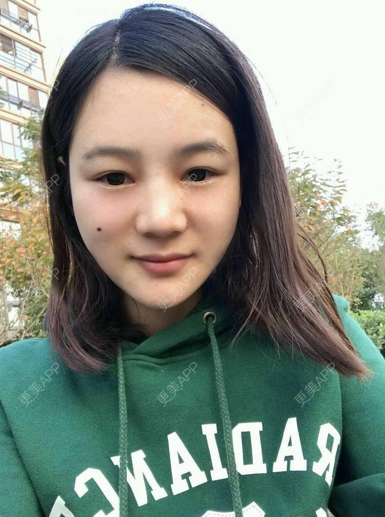 更美 - 刘茜 医生的埋线提升经验 | 埋线提升 | 无锡