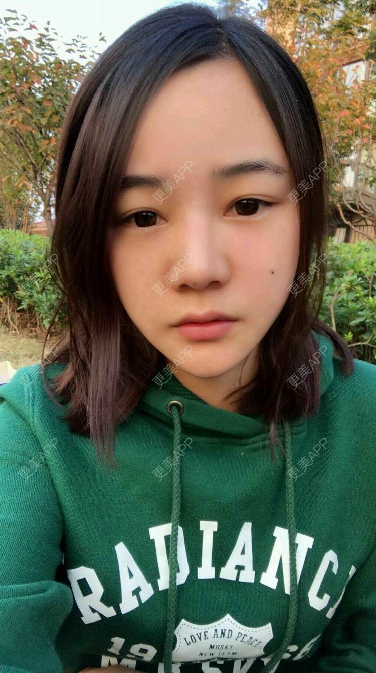 更美 - 刘茜 医生的埋线提升经验 | 埋线提升 | 无锡
