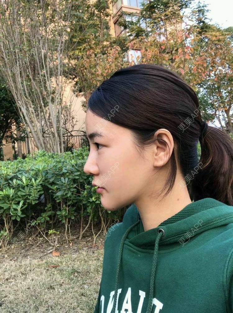 更美 - 刘茜 医生的埋线提升经验 | 埋线提升 | 无锡
