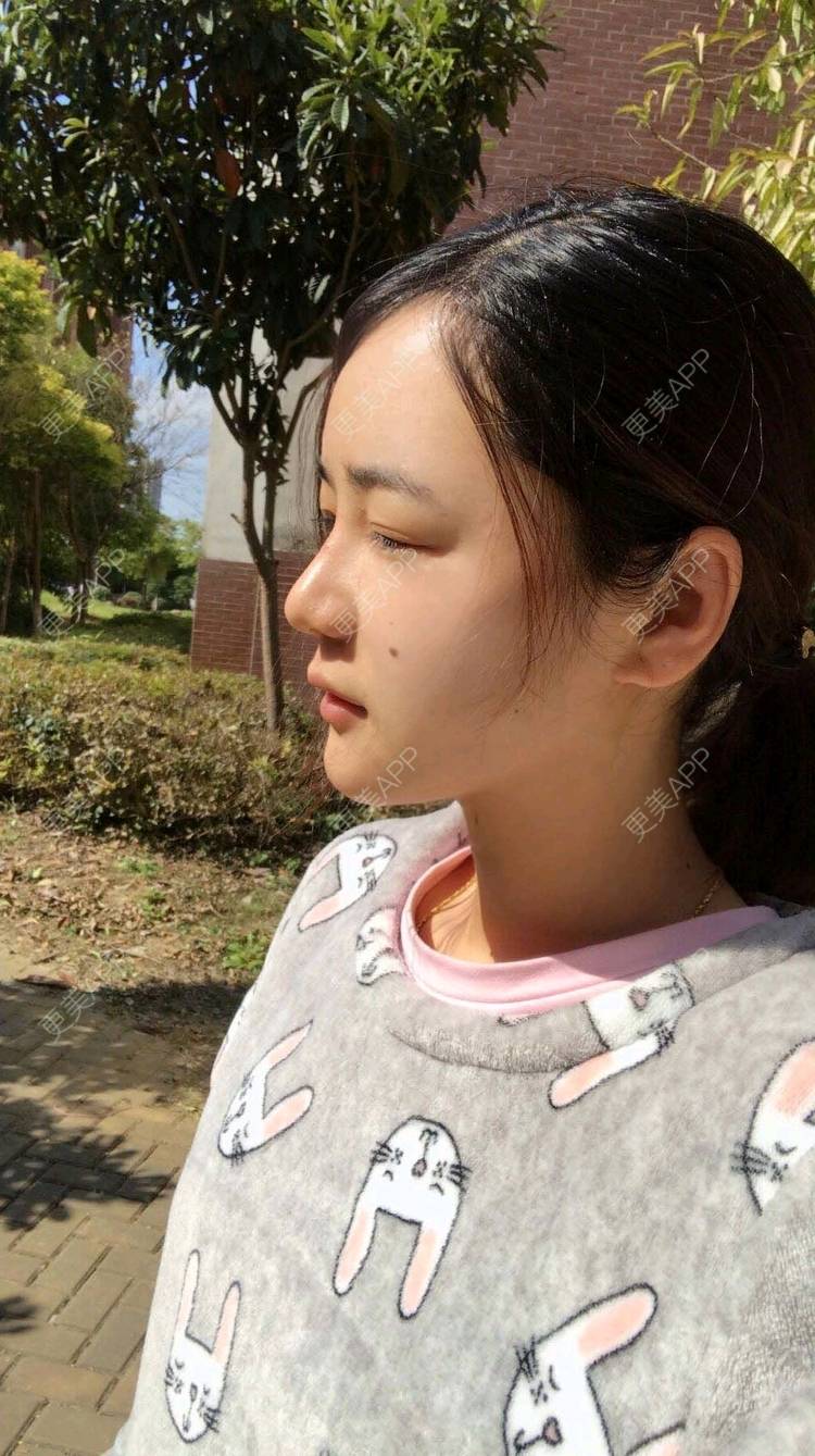 更美 - 刘茜 医生的埋线提升经验 | 埋线提升 | 无锡