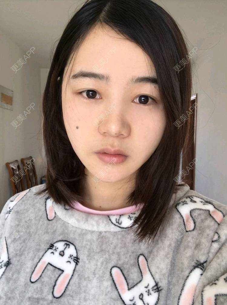 更美 - 刘茜 医生的埋线提升经验 | 埋线提升 | 无锡