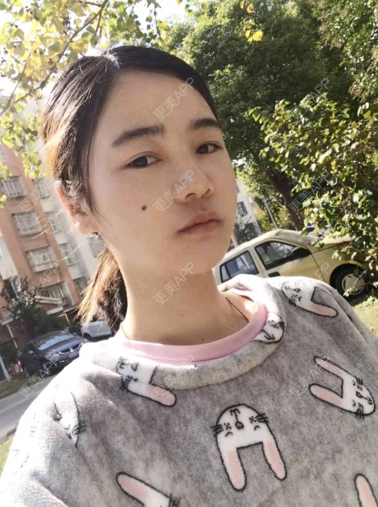 更美 - 刘茜 医生的埋线提升经验 | 埋线提升 | 无锡