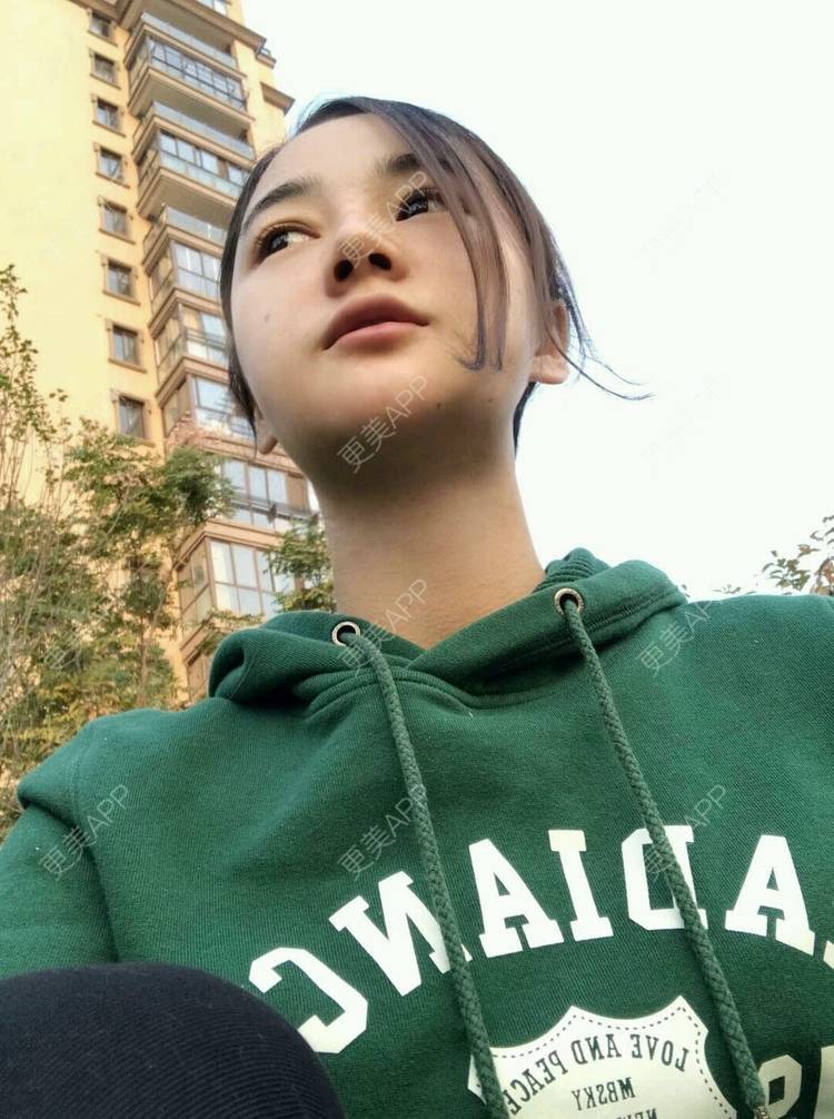 更美 - 刘茜 医生的埋线提升经验 | 埋线提升 | 无锡