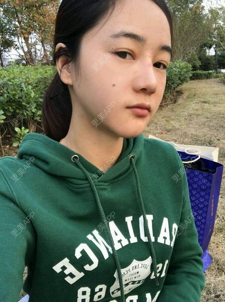 更美 - 刘茜 医生的埋线提升经验 | 埋线提升 | 无锡