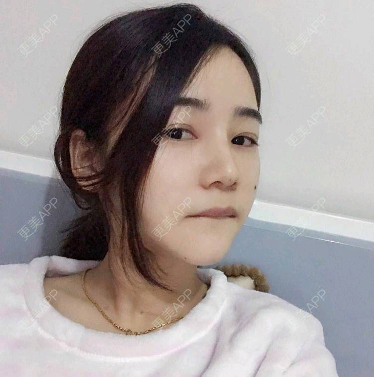 更美 - 刘茜 医生的埋线提升经验 | 埋线提升 | 无锡