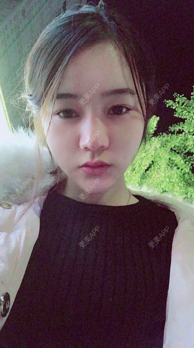 更美 - 刘茜 医生的埋线提升经验 | 埋线提升 | 无锡