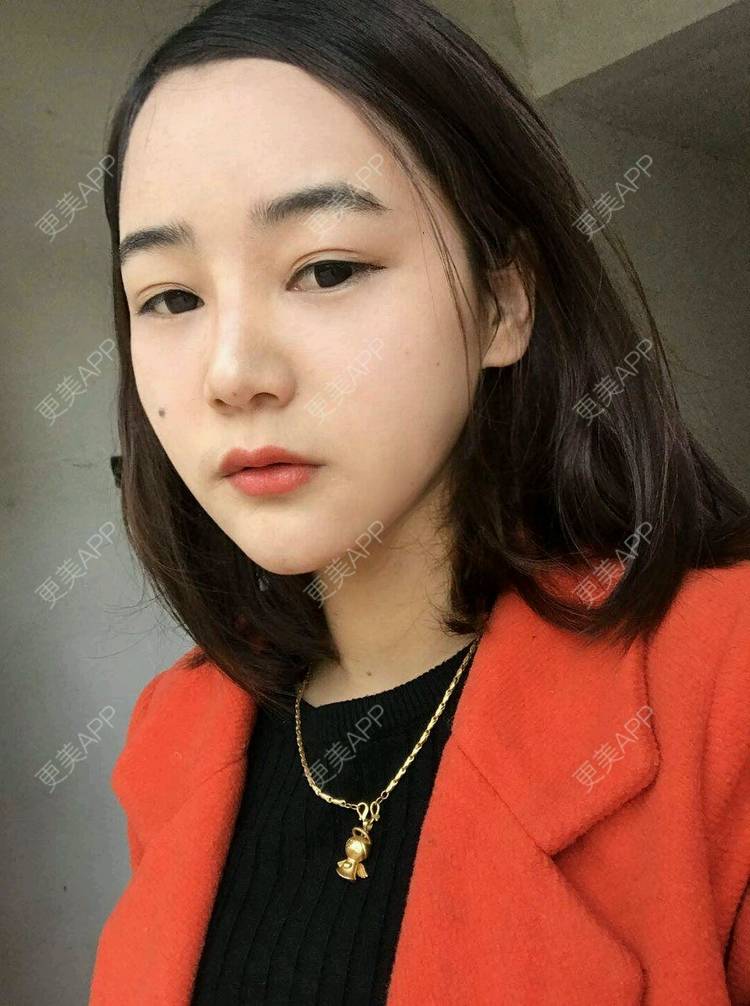 更美 - 刘茜 医生的埋线提升经验 | 埋线提升 | 无锡
