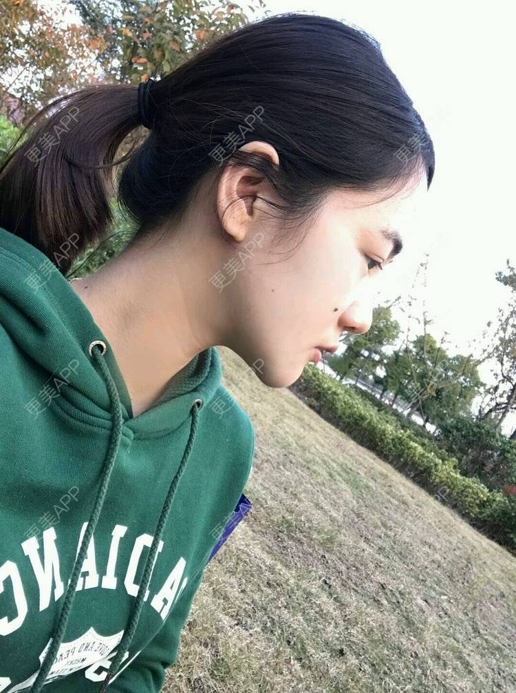 更美 - 刘茜 医生的埋线提升经验 | 埋线提升 | 无锡