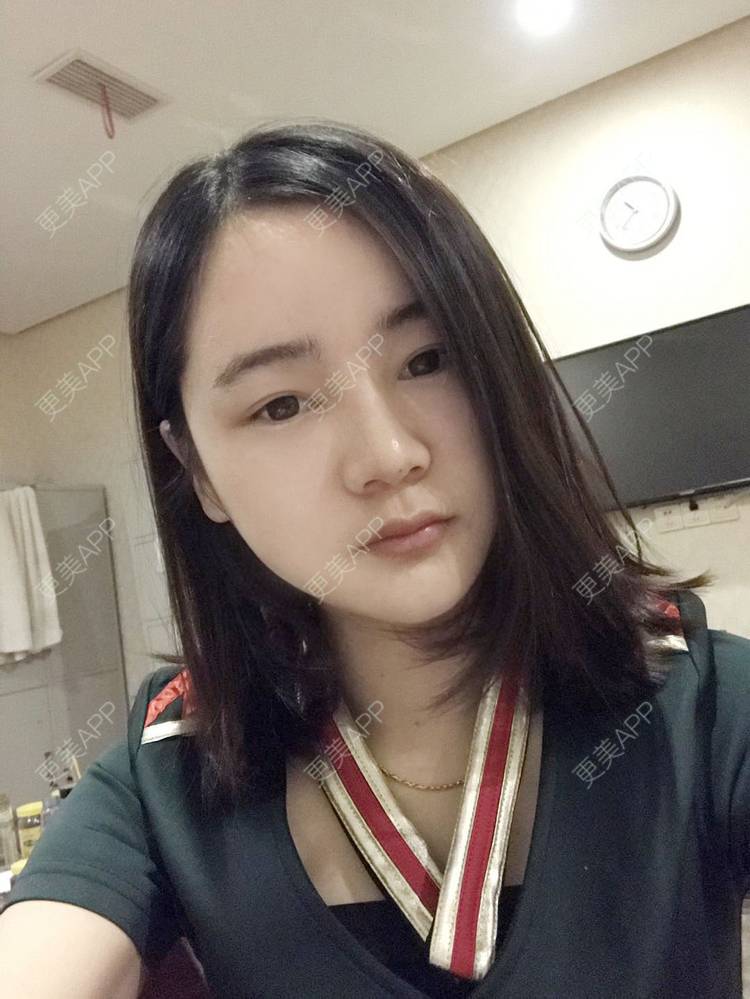 更美 - 刘茜 医生的埋线提升经验 | 埋线提升 | 无锡