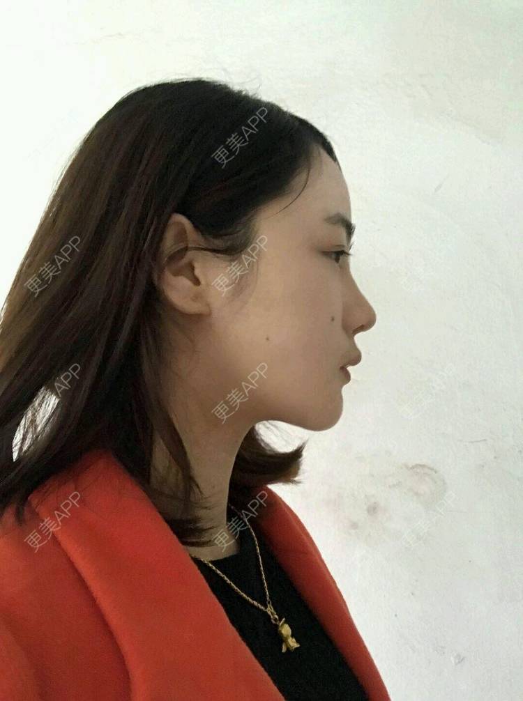 更美 - 刘茜 医生的埋线提升经验 | 埋线提升 | 无锡