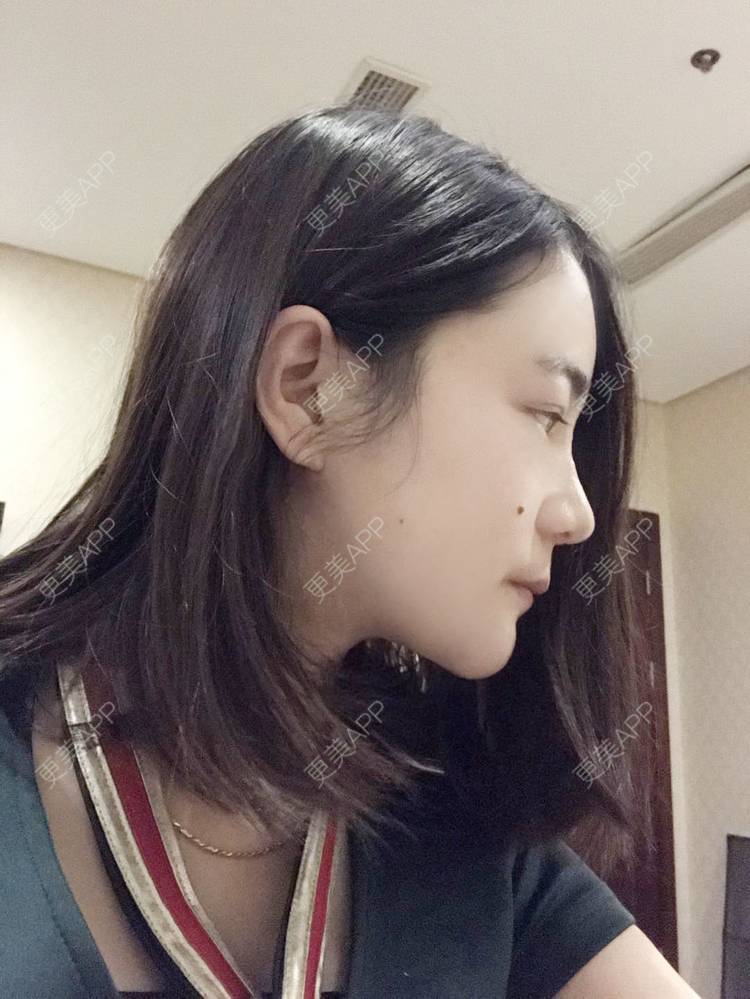 更美 - 刘茜 医生的埋线提升经验 | 埋线提升 | 无锡