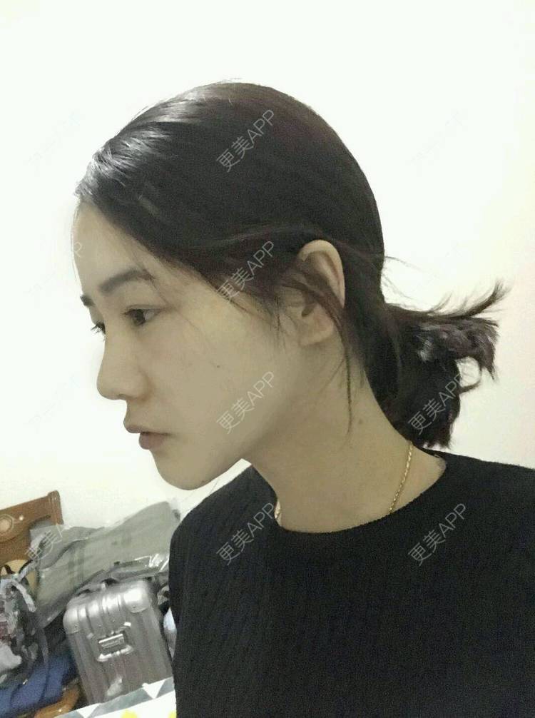 更美 - 刘茜 医生的埋线提升经验 | 埋线提升 | 无锡