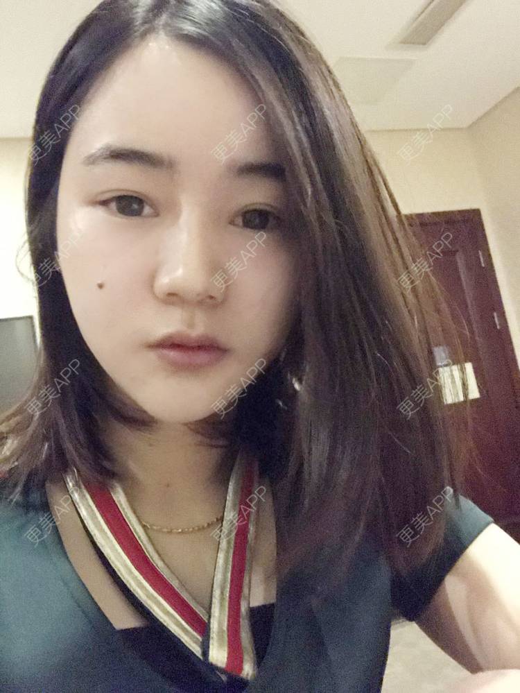 更美 - 刘茜 医生的埋线提升经验 | 埋线提升 | 无锡