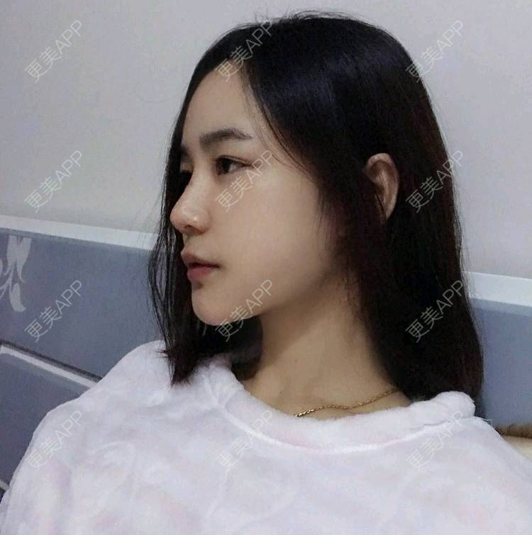 更美 - 刘茜 医生的埋线提升经验 | 埋线提升 | 无锡