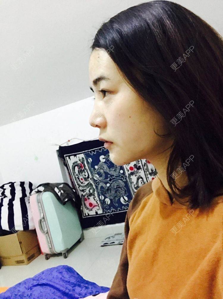 更美 - 刘茜 医生的埋线提升经验 | 埋线提升 | 无锡