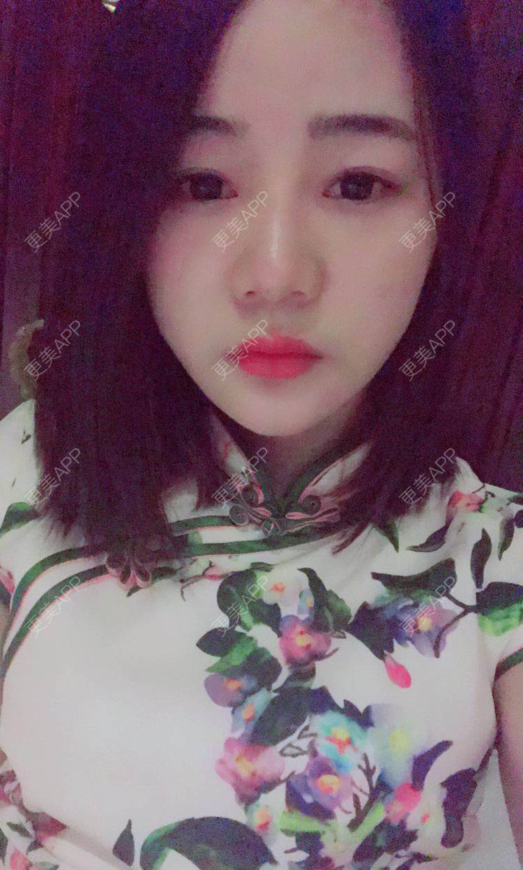 更美 - 刘茜 医生的埋线提升经验 | 埋线提升 | 无锡