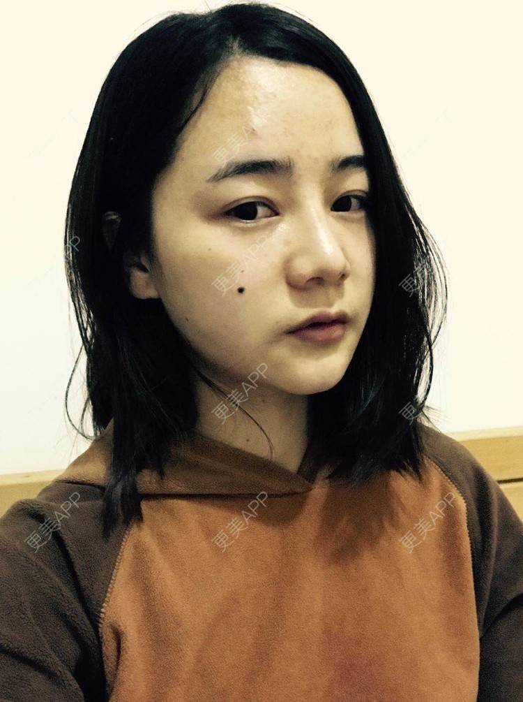 更美 - 刘茜 医生的埋线提升经验 | 埋线提升 | 无锡