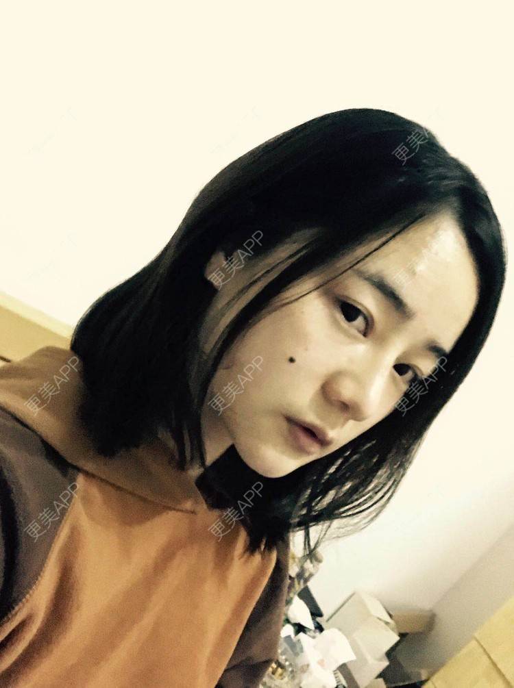 更美 - 刘茜 医生的埋线提升经验 | 埋线提升 | 无锡