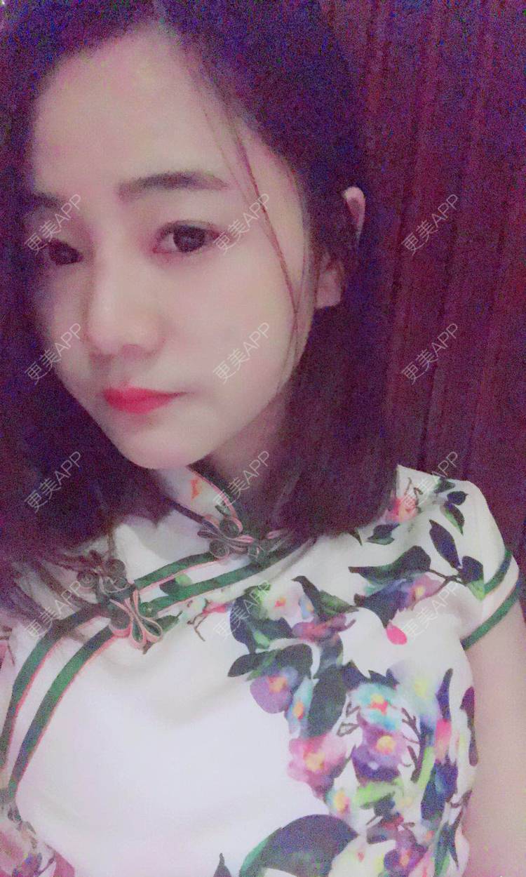 更美 - 刘茜 医生的埋线提升经验 | 埋线提升 | 无锡