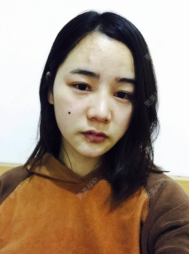 更美 - 刘茜 医生的埋线提升经验 | 埋线提升 | 无锡
