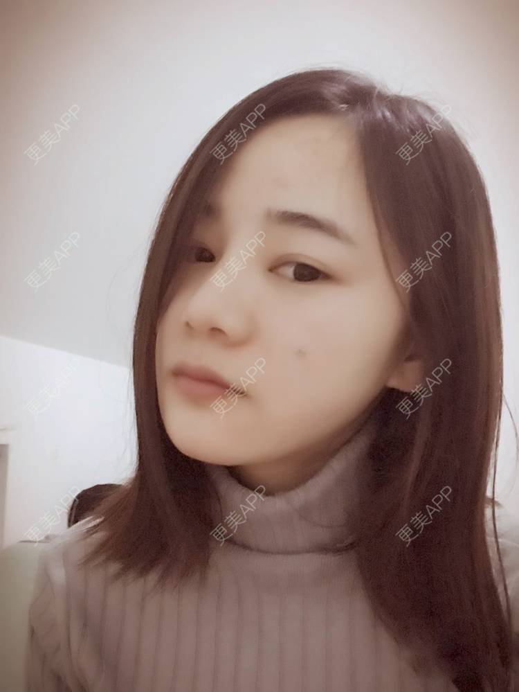 更美 - 刘茜 医生的埋线提升经验 | 埋线提升 | 无锡