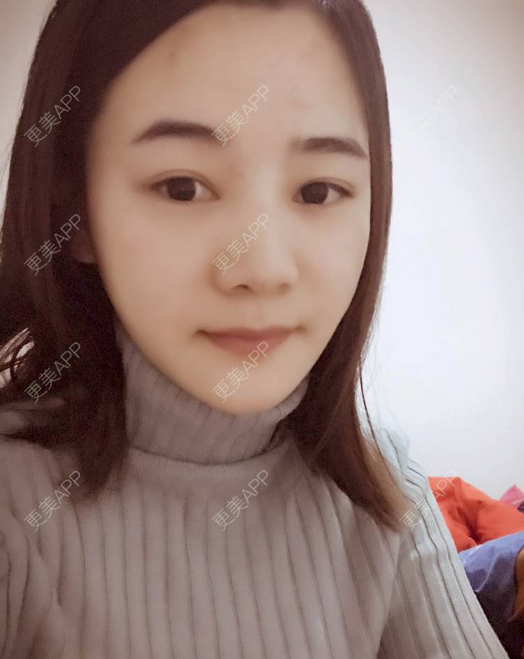 更美 - 刘茜 医生的埋线提升经验 | 埋线提升 | 无锡
