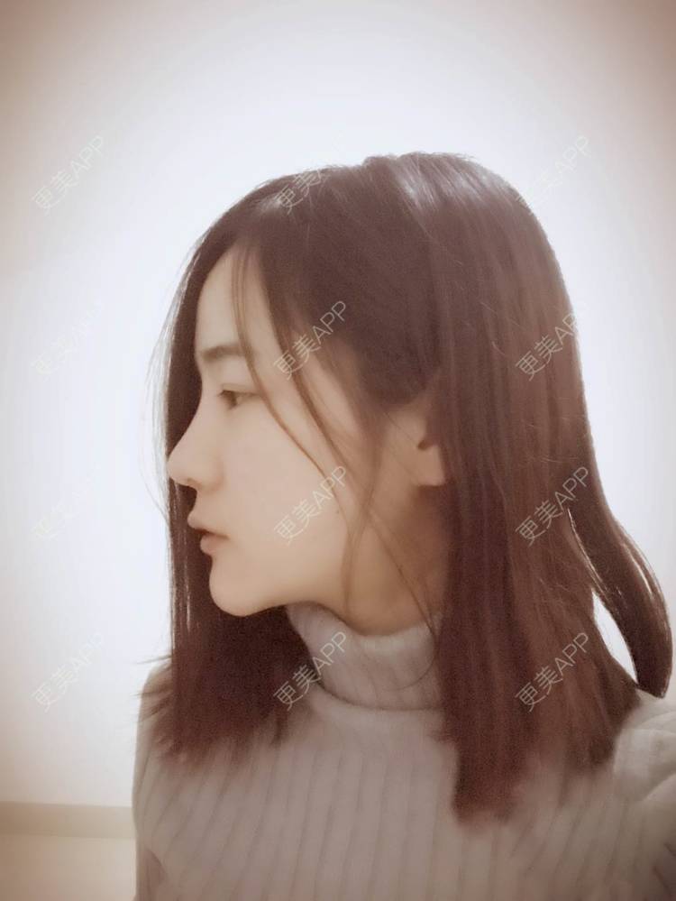 更美 - 刘茜 医生的埋线提升经验 | 埋线提升 | 无锡