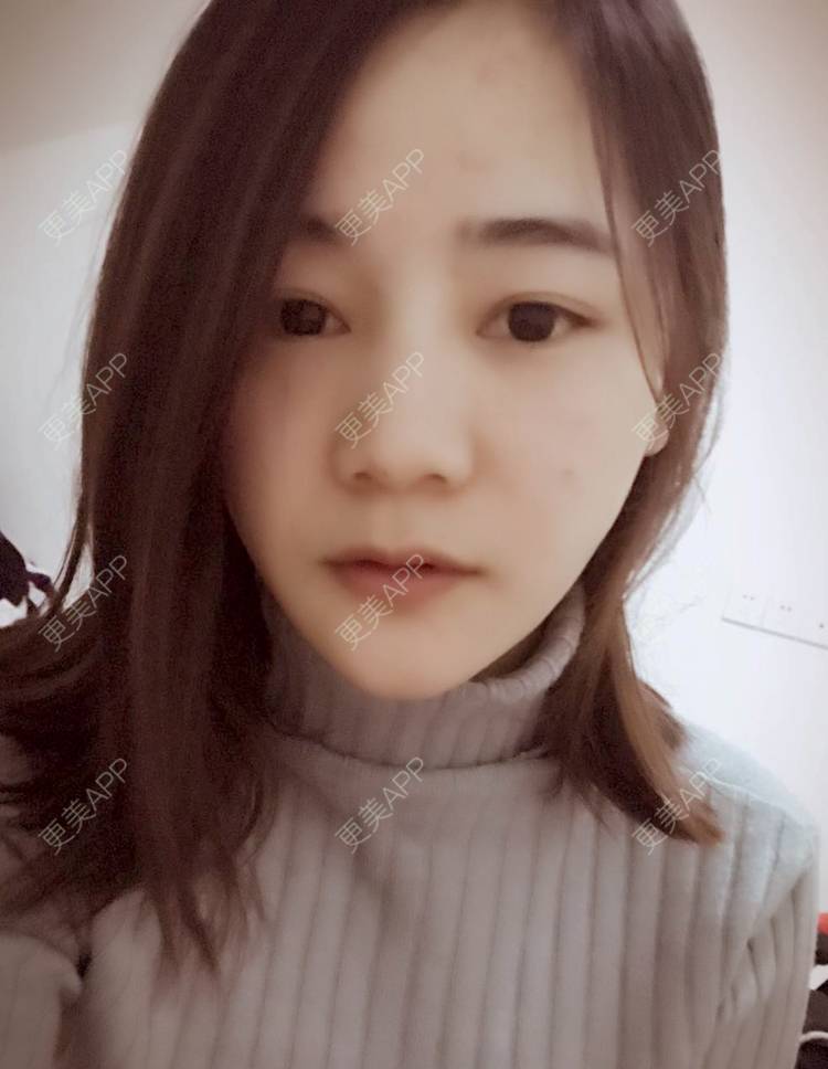 更美 - 刘茜 医生的埋线提升经验 | 埋线提升 | 无锡