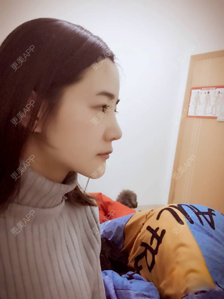 更美 - 刘茜 医生的埋线提升经验 | 埋线提升 | 无锡
