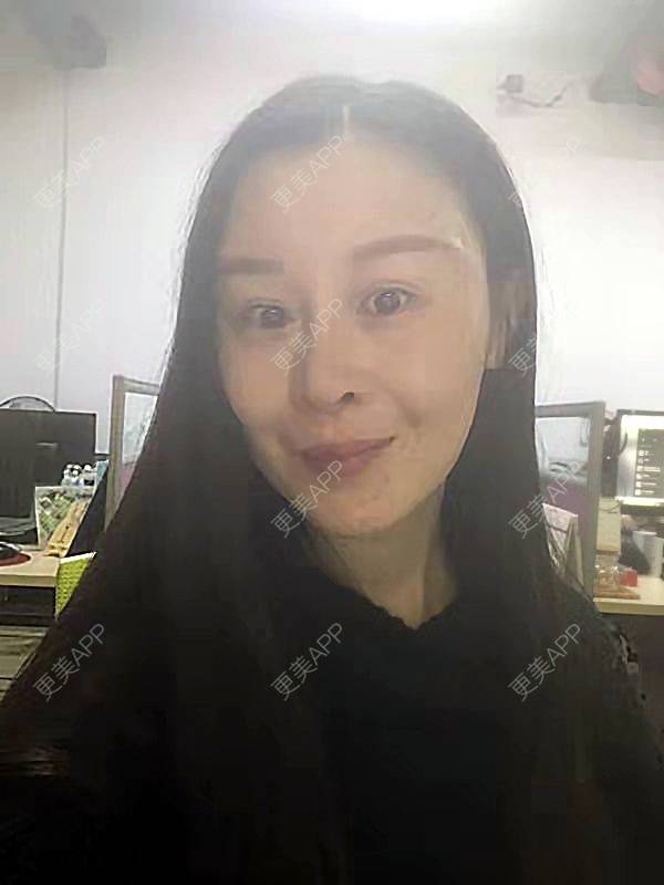 更美 - 冬天的第一场雪的玻尿酸太阳穴经验 | 玻尿酸太阳穴 | 沈阳