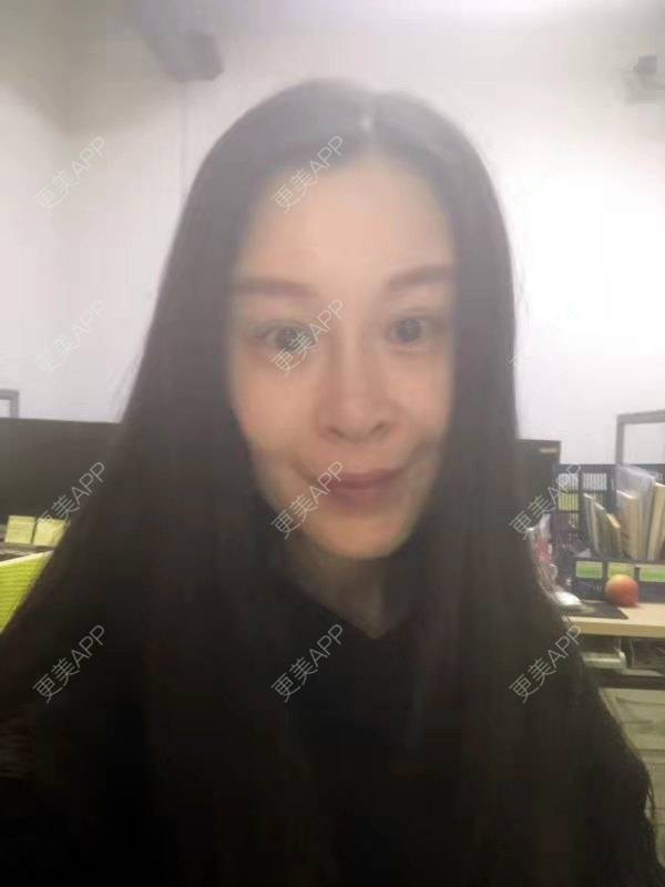 更美 - 冬天的第一场雪的玻尿酸太阳穴经验 | 玻尿酸太阳穴 | 沈阳