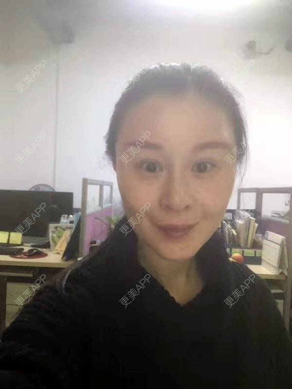 更美 - 冬天的第一场雪的玻尿酸太阳穴经验 | 玻尿酸太阳穴 | 沈阳