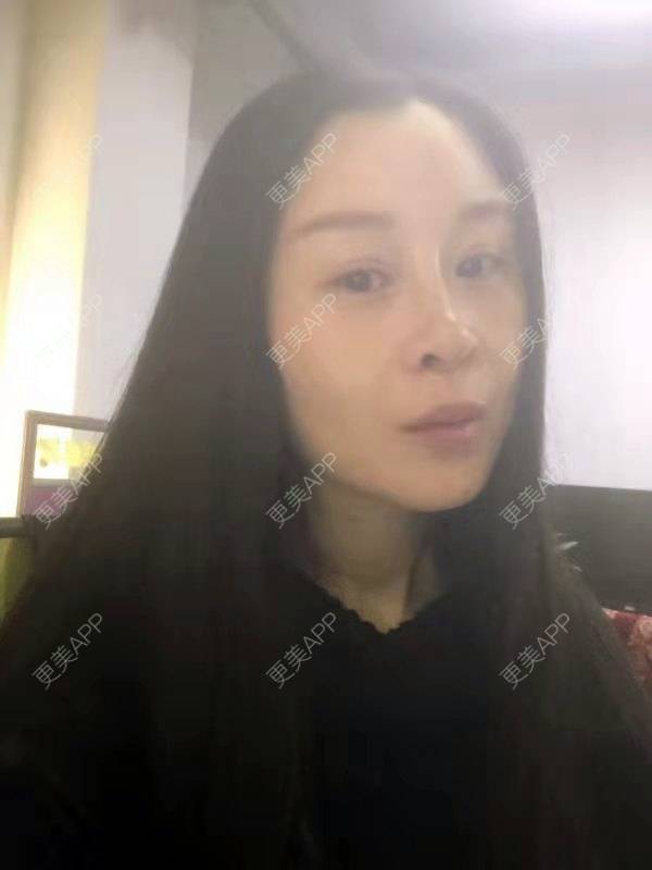更美 - 冬天的第一场雪的玻尿酸太阳穴经验 | 玻尿酸太阳穴 | 沈阳