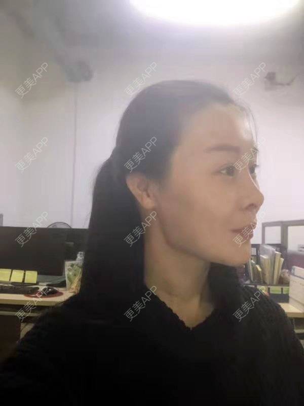 更美 - 冬天的第一场雪的玻尿酸太阳穴经验 | 玻尿酸太阳穴 | 沈阳