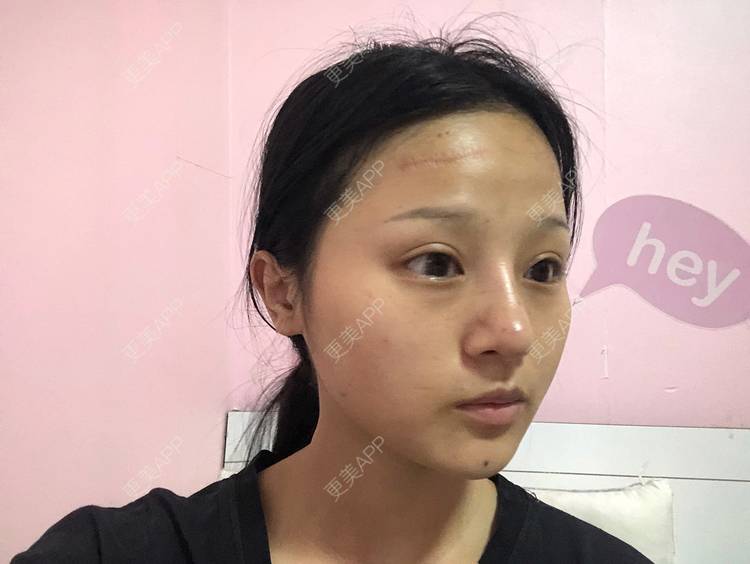 更美 - 更美用户h3eiJuwKGo的激光淡疤经验 | 综合淡疤 | 注射淡疤 | 激光淡疤 | 成都