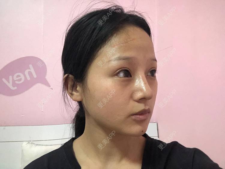 更美 - 更美用户h3eiJuwKGo的激光淡疤经验 | 综合淡疤 | 注射淡疤 | 激光淡疤 | 成都