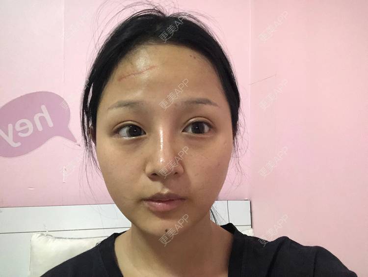 更美 - 更美用户h3eiJuwKGo的激光淡疤经验 | 综合淡疤 | 注射淡疤 | 激光淡疤 | 成都