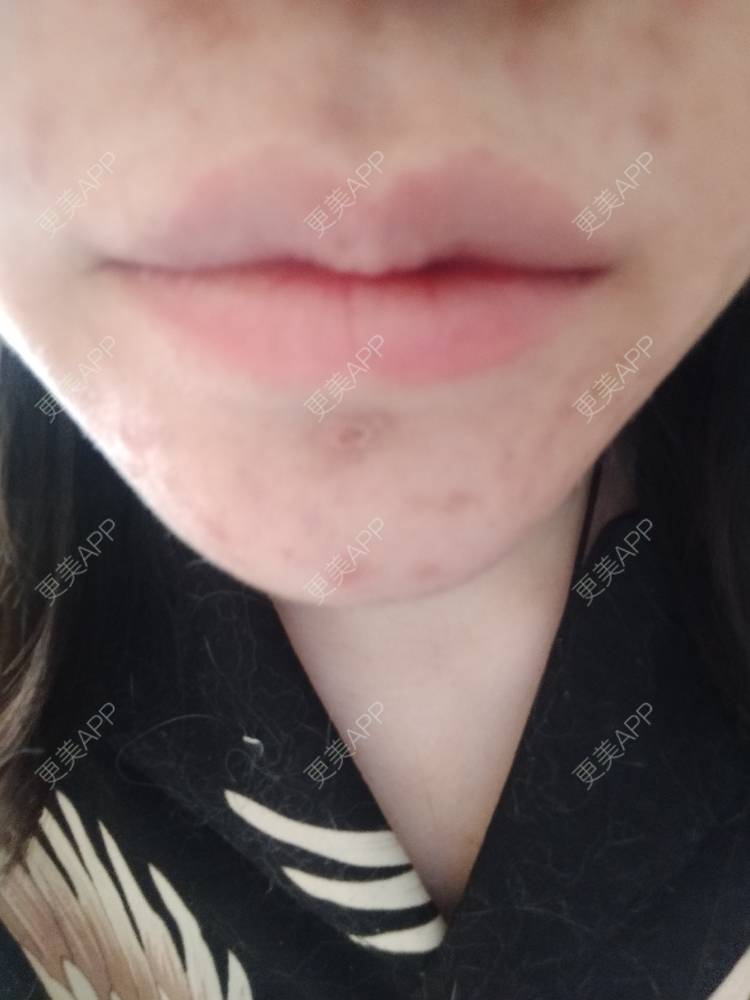 更美 - 更美用户tdlYc04CJi的面部脱毛经验 | 面部脱毛 | 上海