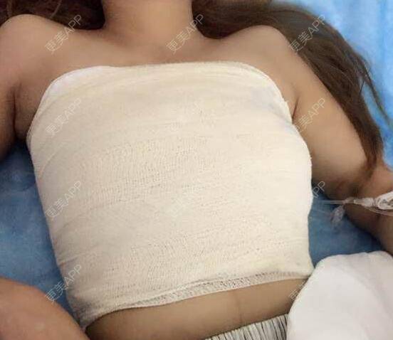 更美 - 初秋繁华落尽的假体隆胸经验 | 假体隆胸 | 南京