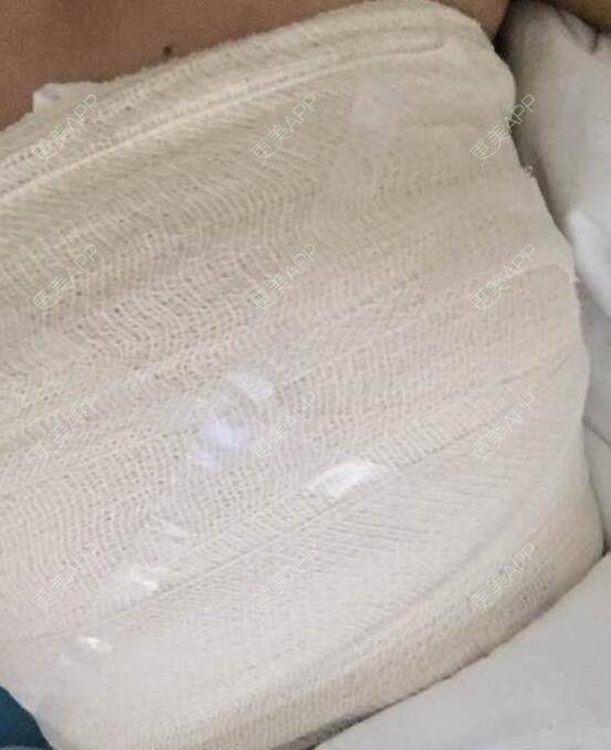 更美 - 初秋繁华落尽的假体隆胸经验 | 假体隆胸 | 南京